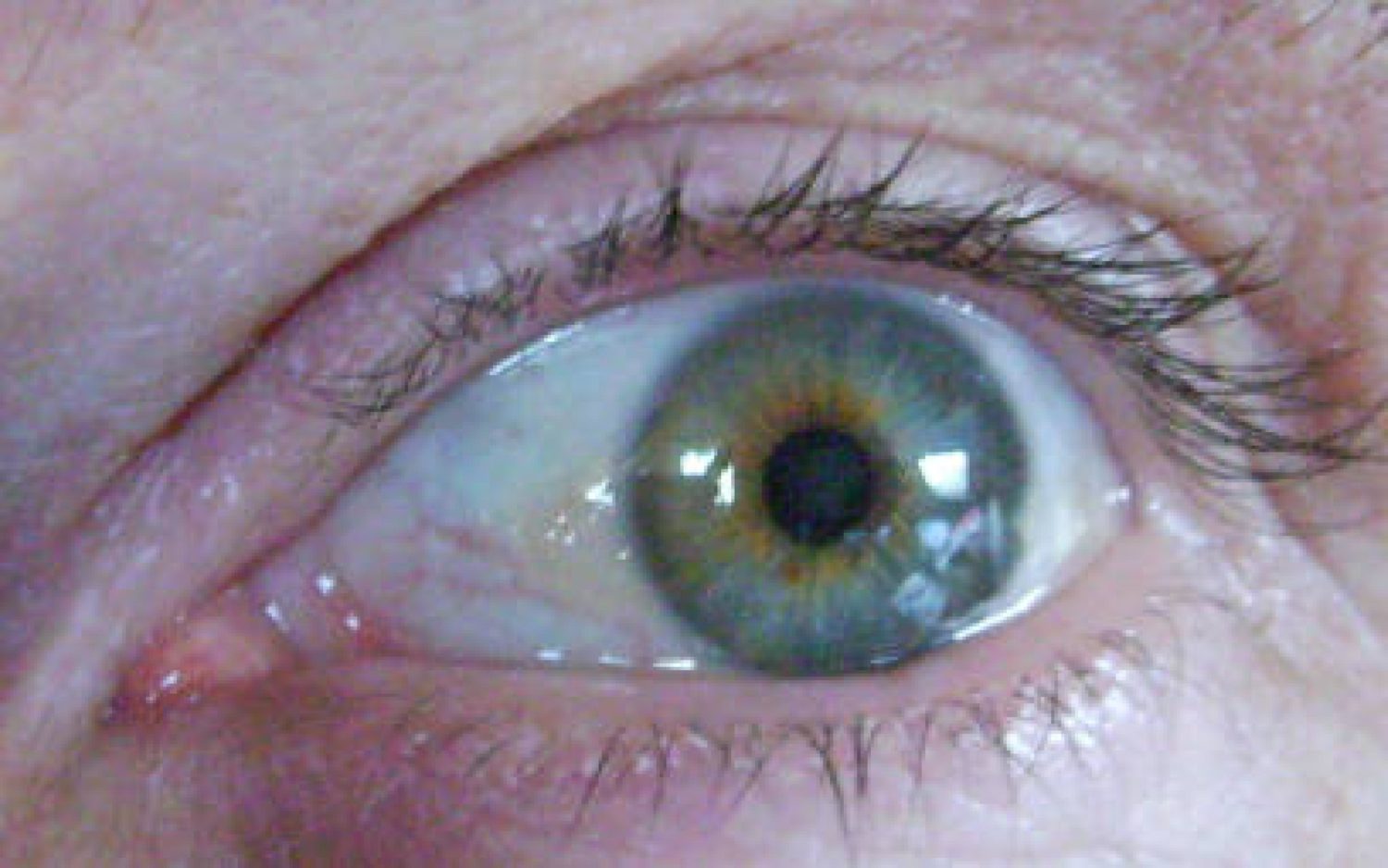 Weißgelber Fleck im Auge (Pinguecula) was ist das? VISUS Contactlinsen Weißgelber Fleck im Auge (Pinguecula) was ist das? VISUS Contactlinsen